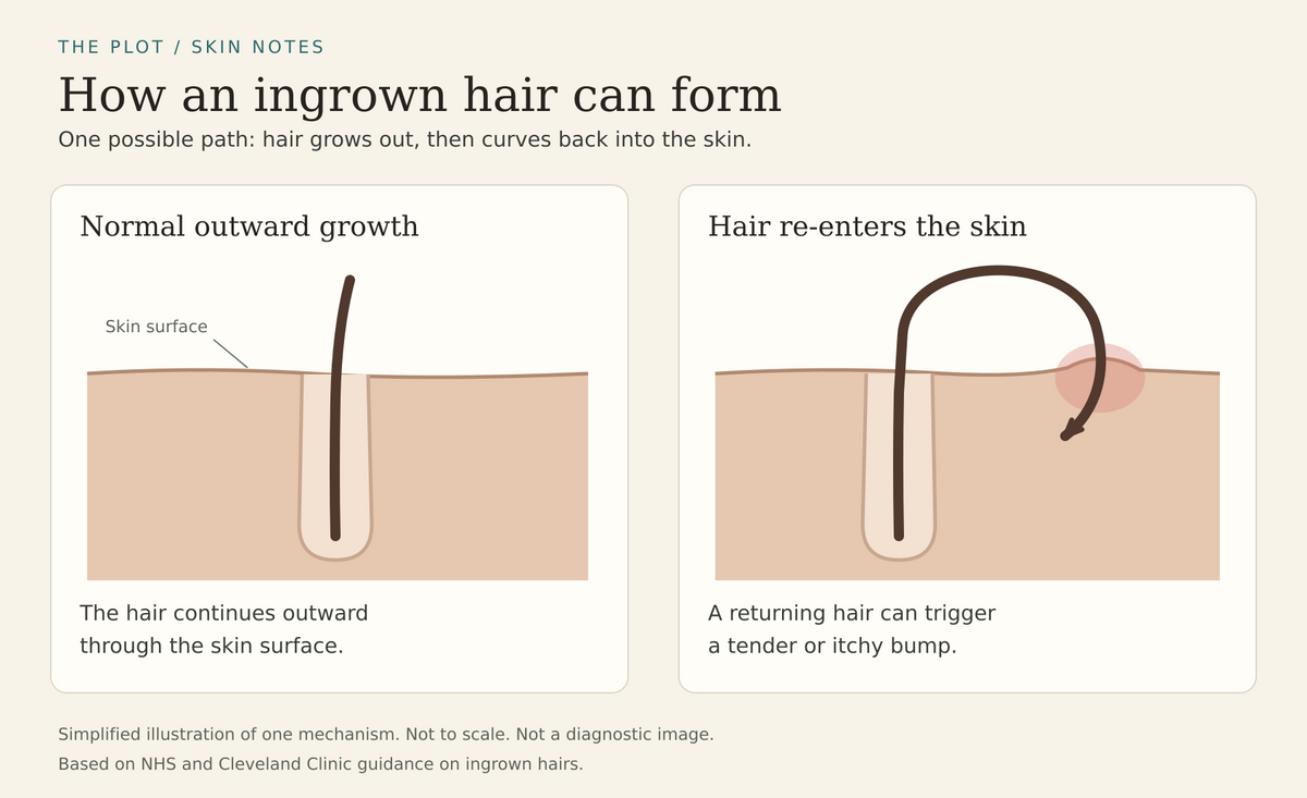 Diagram comparing outward hair growth with a hair curving back into the skin and causing a bump.